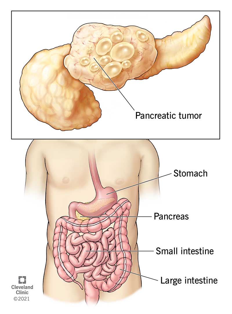 Pancreatic cancer: Cellular process suggests path to new treatment options