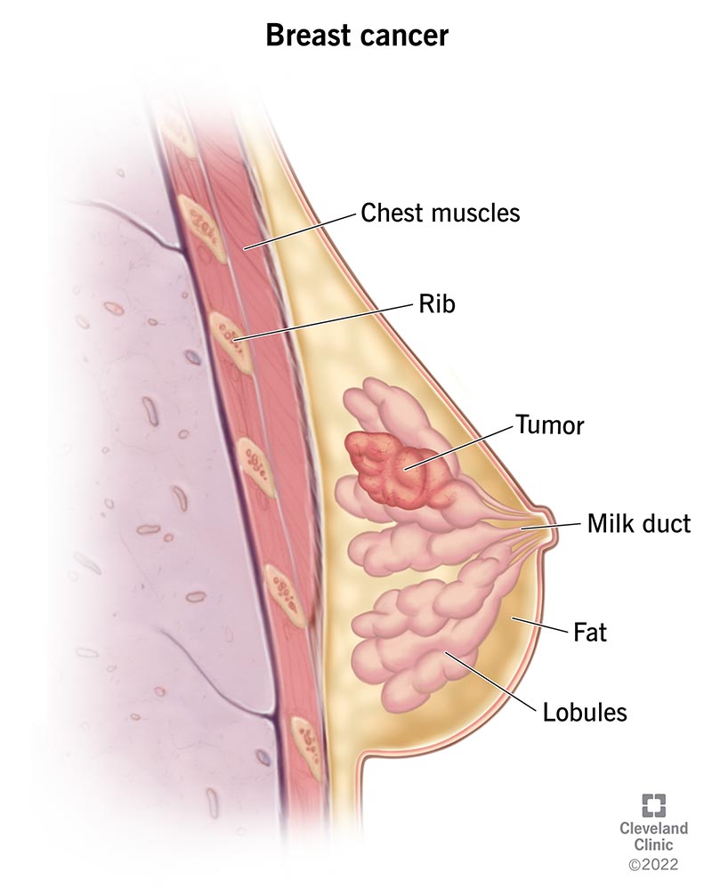 How the immune system responds to tissue damage can aid cancer spread