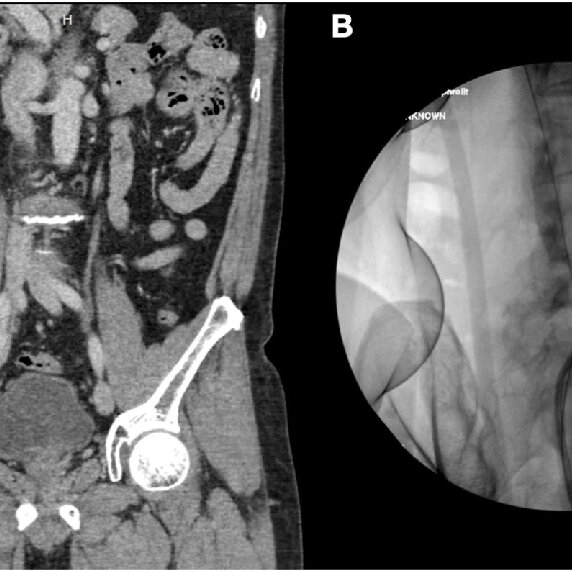 A giant ureteric calculus successfully removed by mini-endoscopic combined intrarenal surgery: A case report