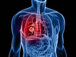 Surprise small-cell lung cancer discovery suggests new treatment