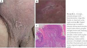 Perianal and scrotal porokeratosis ptychotropica. Case report of an unusual condition, and review of the literature