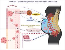 New Insights into Ovarian Cancer Resistance to Immunotherapy