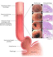 Innovative Strategies for Cost-Effective Diagnosis of Barrett's Esophagus