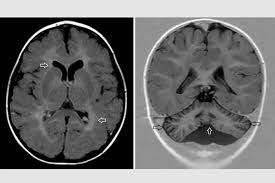 WashU Medicine Identifies New Genetic Disorder Linked to Brain Malformations